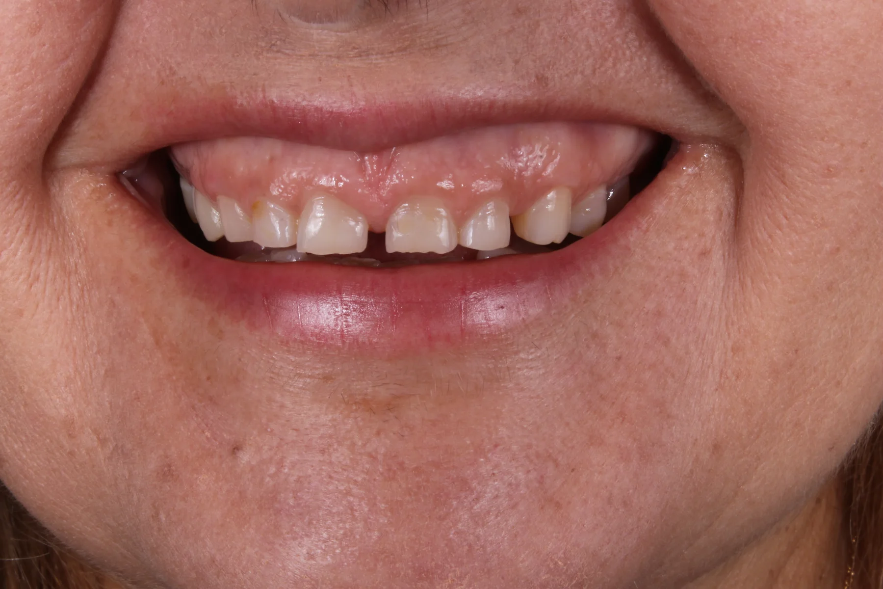 Antes do caso clínico 17