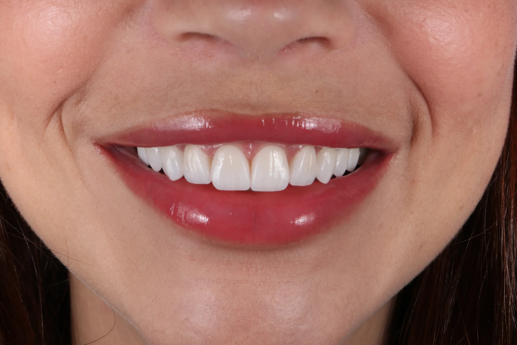 Resultado real de tratamento com laminados cerâmicos realizado pela Due Odontologia